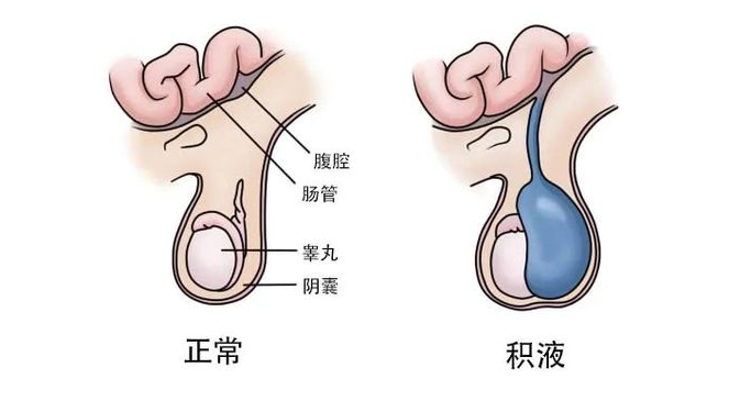 家有男宝看过来这个地方突然变大不及时处理可能会影响生育