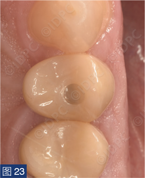 曲面断层怎么使用【精选案例】使用个性化愈合基台的4型种植体植入——全数字化修复流程《口腔种植专刊》_https://www.jmylbn.com_新闻资讯_第23张