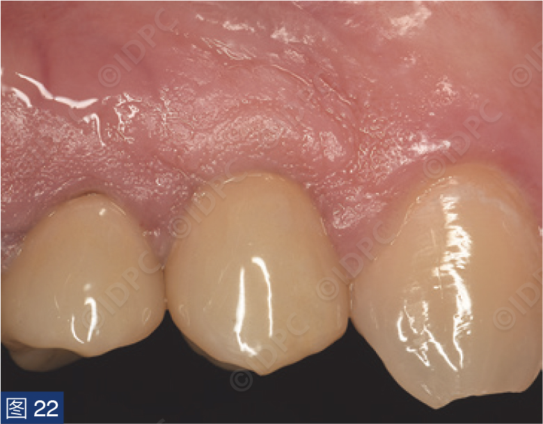 曲面断层怎么使用【精选案例】使用个性化愈合基台的4型种植体植入——全数字化修复流程《口腔种植专刊》_https://www.jmylbn.com_新闻资讯_第22张