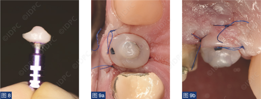 曲面断层怎么使用【精选案例】使用个性化愈合基台的4型种植体植入——全数字化修复流程《口腔种植专刊》_https://www.jmylbn.com_新闻资讯_第11张