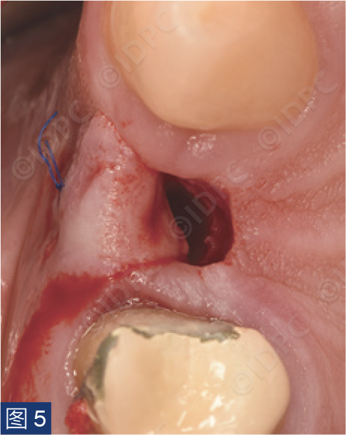 曲面断层怎么使用【精选案例】使用个性化愈合基台的4型种植体植入——全数字化修复流程《口腔种植专刊》_https://www.jmylbn.com_新闻资讯_第8张