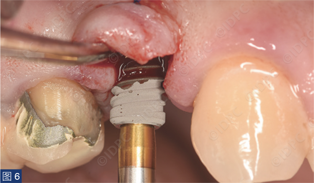 曲面断层怎么使用【精选案例】使用个性化愈合基台的4型种植体植入——全数字化修复流程《口腔种植专刊》_https://www.jmylbn.com_新闻资讯_第9张
