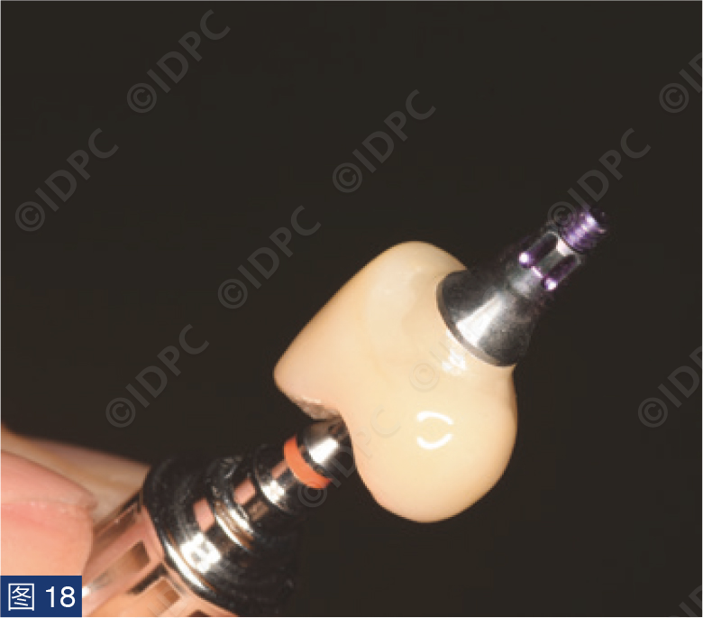 曲面断层怎么使用【精选案例】使用个性化愈合基台的4型种植体植入——全数字化修复流程《口腔种植专刊》_https://www.jmylbn.com_新闻资讯_第19张