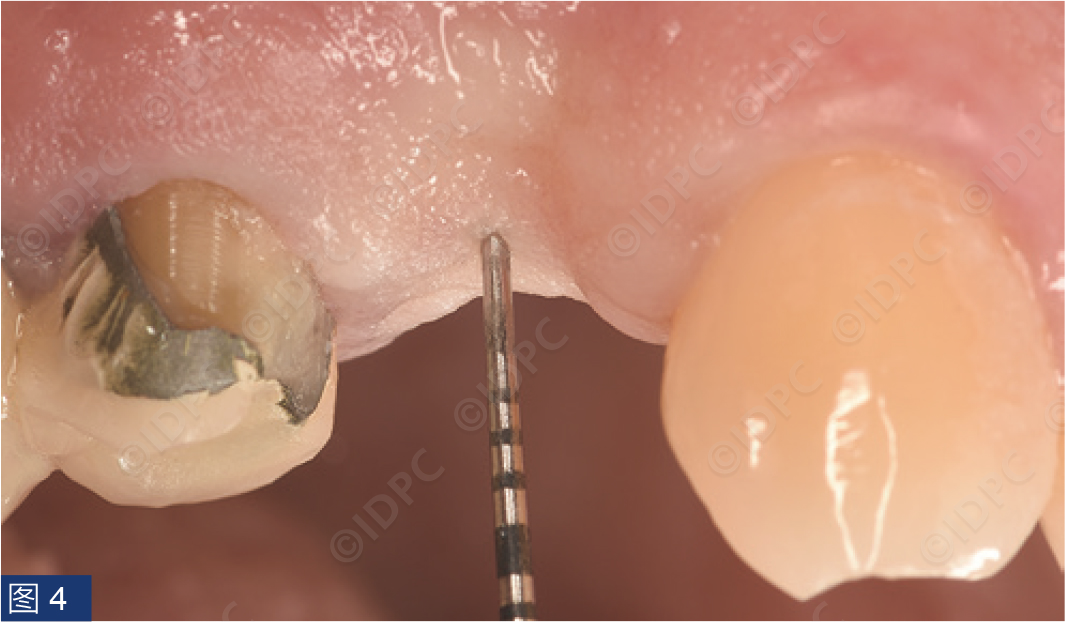 曲面断层怎么使用【精选案例】使用个性化愈合基台的4型种植体植入——全数字化修复流程《口腔种植专刊》_https://www.jmylbn.com_新闻资讯_第7张