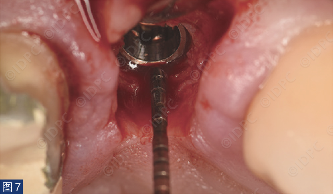 曲面断层怎么使用【精选案例】使用个性化愈合基台的4型种植体植入——全数字化修复流程《口腔种植专刊》_https://www.jmylbn.com_新闻资讯_第10张