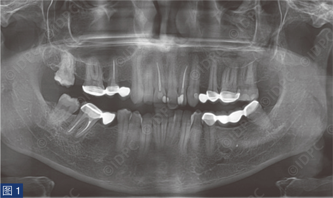 曲面断层怎么使用【精选案例】使用个性化愈合基台的4型种植体植入——全数字化修复流程《口腔种植专刊》_https://www.jmylbn.com_新闻资讯_第5张