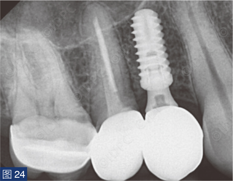 曲面断层怎么使用【精选案例】使用个性化愈合基台的4型种植体植入——全数字化修复流程《口腔种植专刊》_https://www.jmylbn.com_新闻资讯_第24张