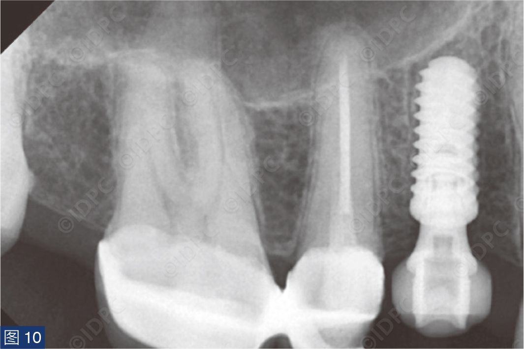 曲面断层怎么使用【精选案例】使用个性化愈合基台的4型种植体植入——全数字化修复流程《口腔种植专刊》_https://www.jmylbn.com_新闻资讯_第12张