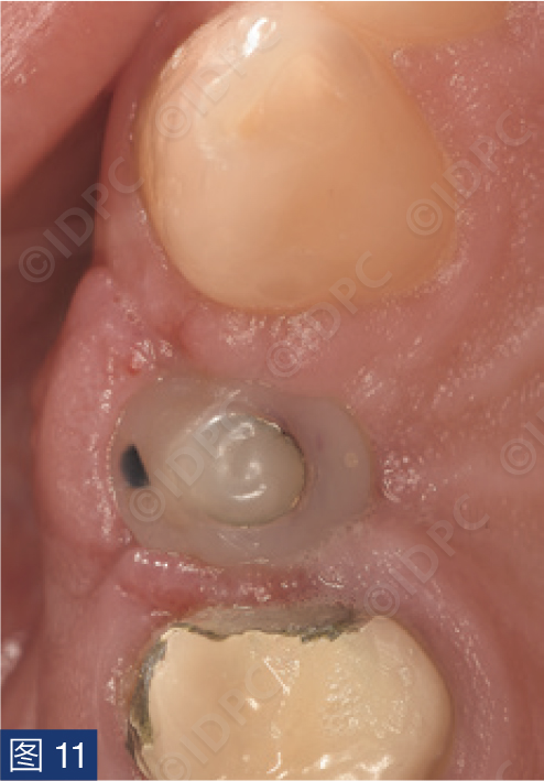 曲面断层怎么使用【精选案例】使用个性化愈合基台的4型种植体植入——全数字化修复流程《口腔种植专刊》_https://www.jmylbn.com_新闻资讯_第13张