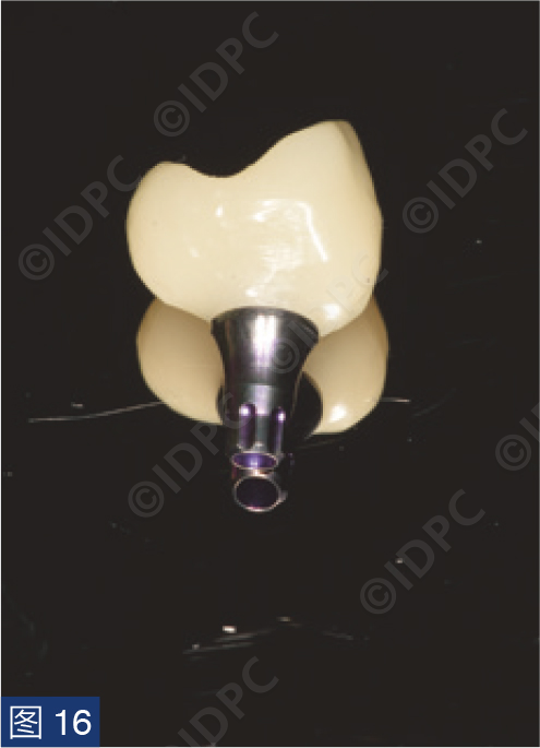 曲面断层怎么使用【精选案例】使用个性化愈合基台的4型种植体植入——全数字化修复流程《口腔种植专刊》_https://www.jmylbn.com_新闻资讯_第17张