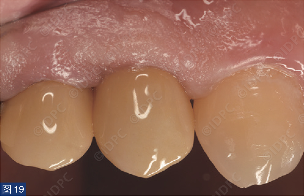 曲面断层怎么使用【精选案例】使用个性化愈合基台的4型种植体植入——全数字化修复流程《口腔种植专刊》_https://www.jmylbn.com_新闻资讯_第20张