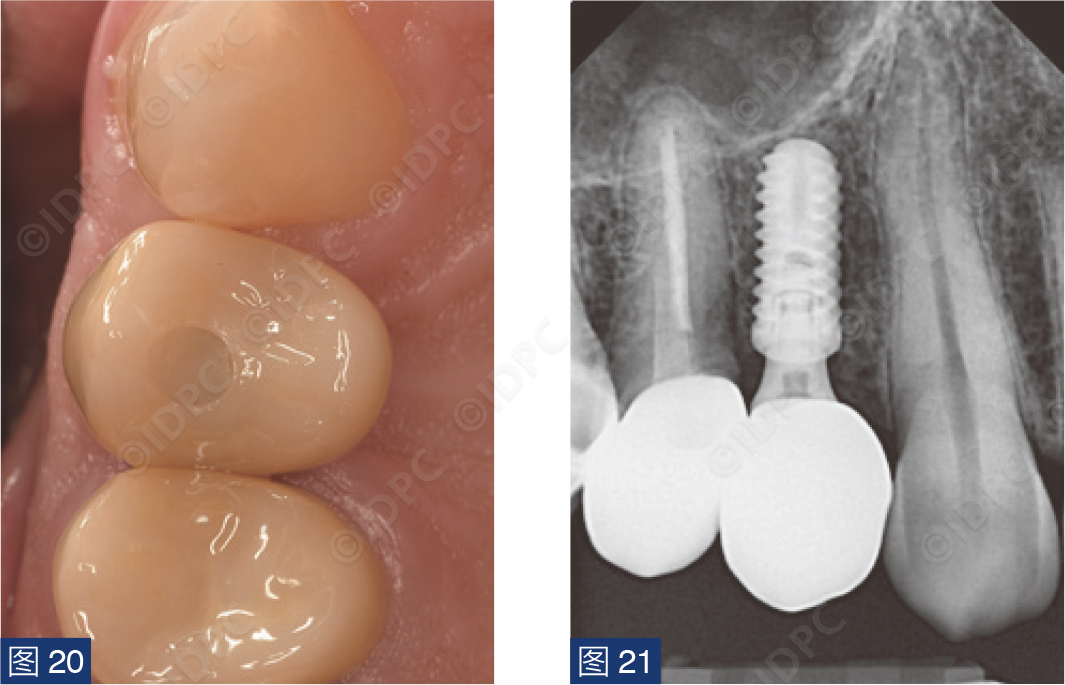 曲面断层怎么使用【精选案例】使用个性化愈合基台的4型种植体植入——全数字化修复流程《口腔种植专刊》_https://www.jmylbn.com_新闻资讯_第21张