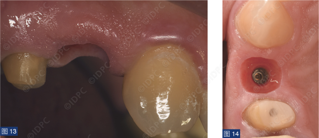 曲面断层怎么使用【精选案例】使用个性化愈合基台的4型种植体植入——全数字化修复流程《口腔种植专刊》_https://www.jmylbn.com_新闻资讯_第15张