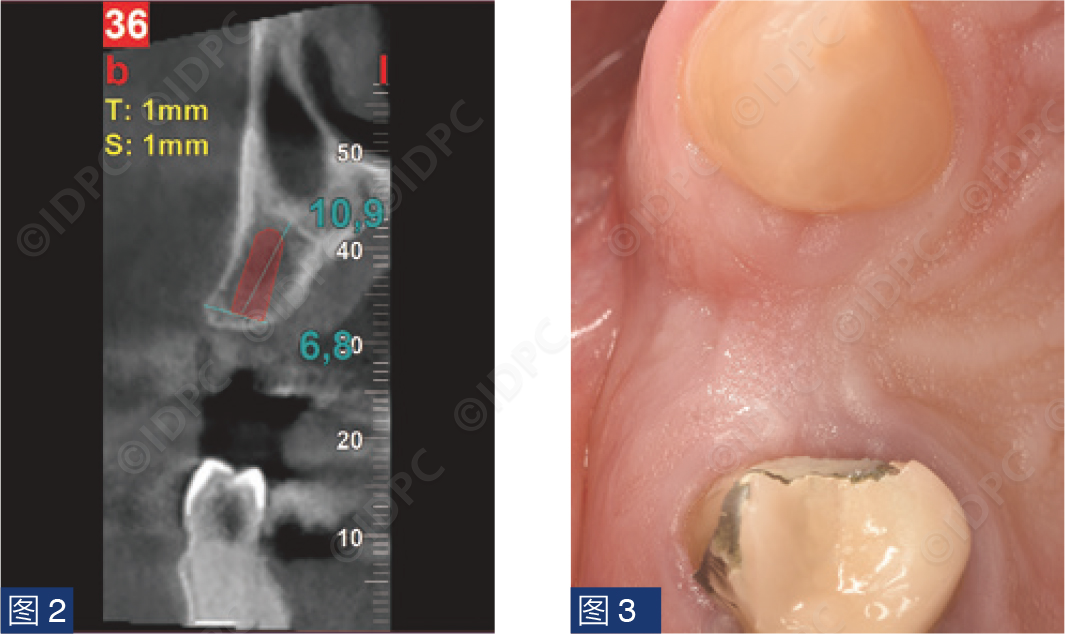 曲面断层怎么使用【精选案例】使用个性化愈合基台的4型种植体植入——全数字化修复流程《口腔种植专刊》_https://www.jmylbn.com_新闻资讯_第6张
