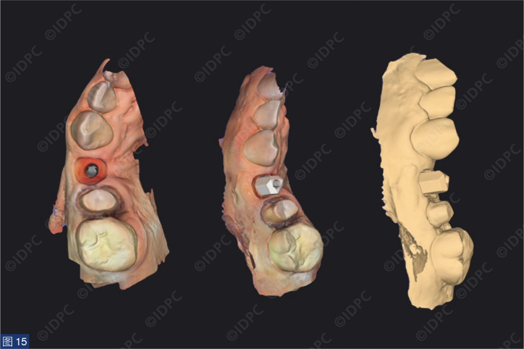 曲面断层怎么使用【精选案例】使用个性化愈合基台的4型种植体植入——全数字化修复流程《口腔种植专刊》_https://www.jmylbn.com_新闻资讯_第16张