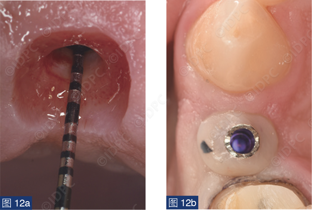 曲面断层怎么使用【精选案例】使用个性化愈合基台的4型种植体植入——全数字化修复流程《口腔种植专刊》_https://www.jmylbn.com_新闻资讯_第14张