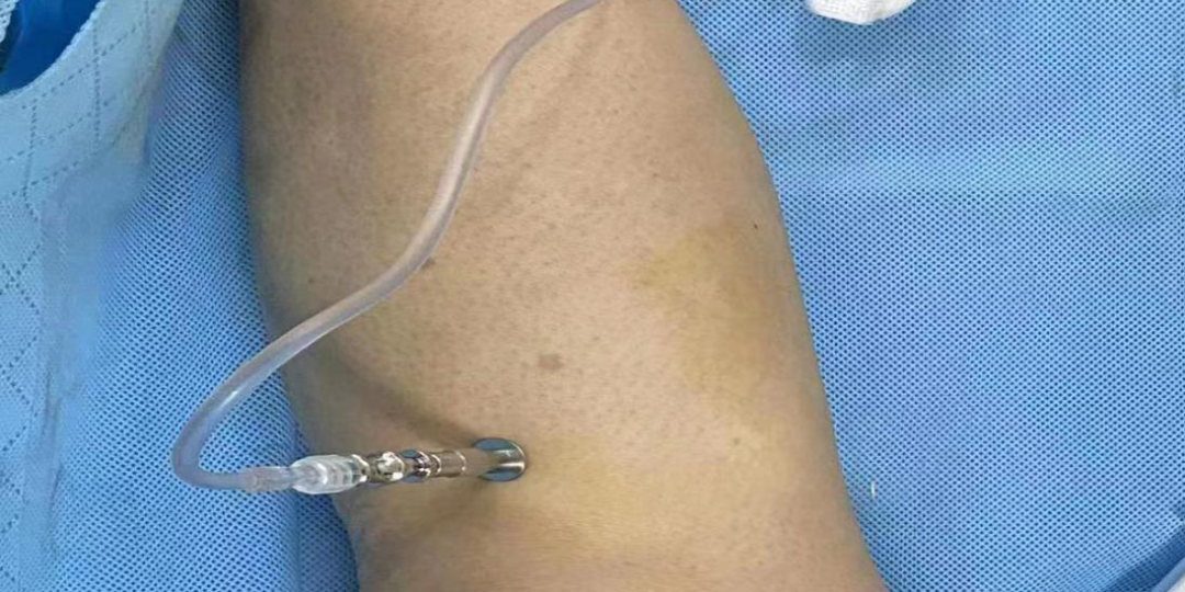 为什么输血不能用小针急症患者失血过多，输血找不到血管怎么办？这项技术来救场！_https://www.jmylbn.com_新闻资讯_第2张