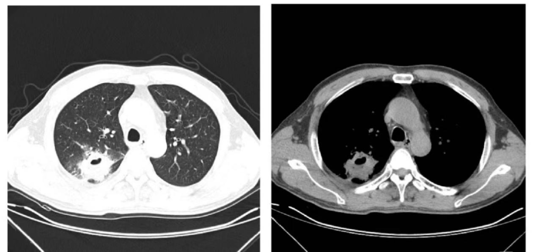 体检dr是什么意思【医学科普】胸部体检选择DR胸片还是CT？_https://www.jmylbn.com_新闻资讯_第4张