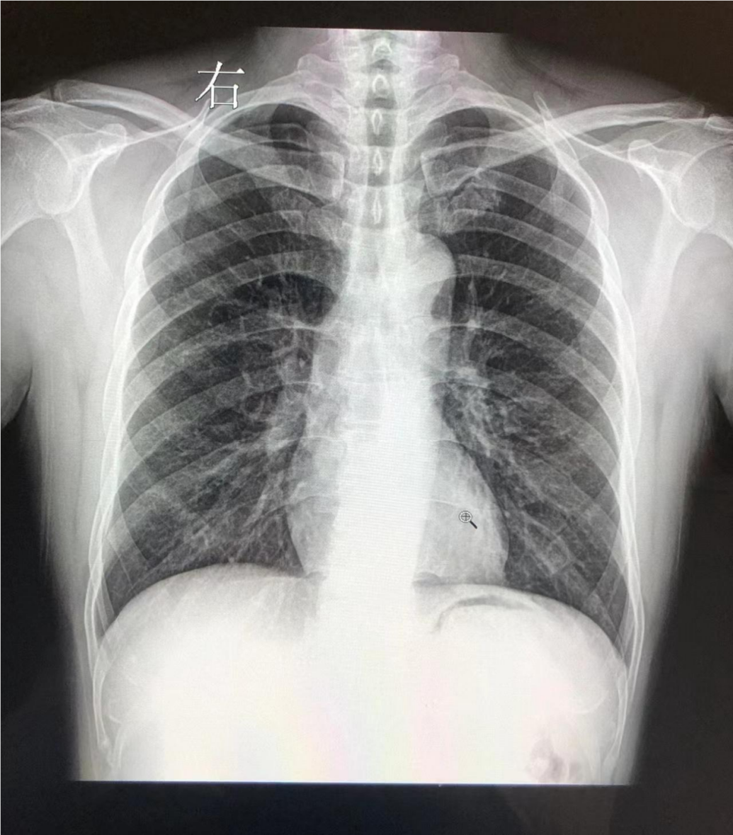 体检dr是什么意思【医学科普】胸部体检选择DR胸片还是CT？_https://www.jmylbn.com_新闻资讯_第2张