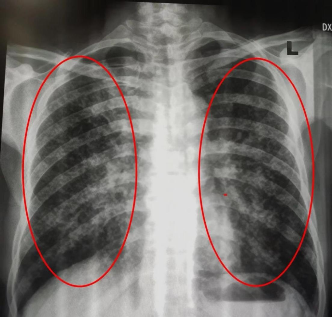 体检dr是什么意思【医学科普】胸部体检选择DR胸片还是CT？_https://www.jmylbn.com_新闻资讯_第3张