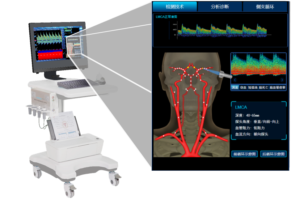 tcd2000怎么样【体检新动态】经颅多普勒在健康体检中的应用_https://www.jmylbn.com_新闻资讯_第4张