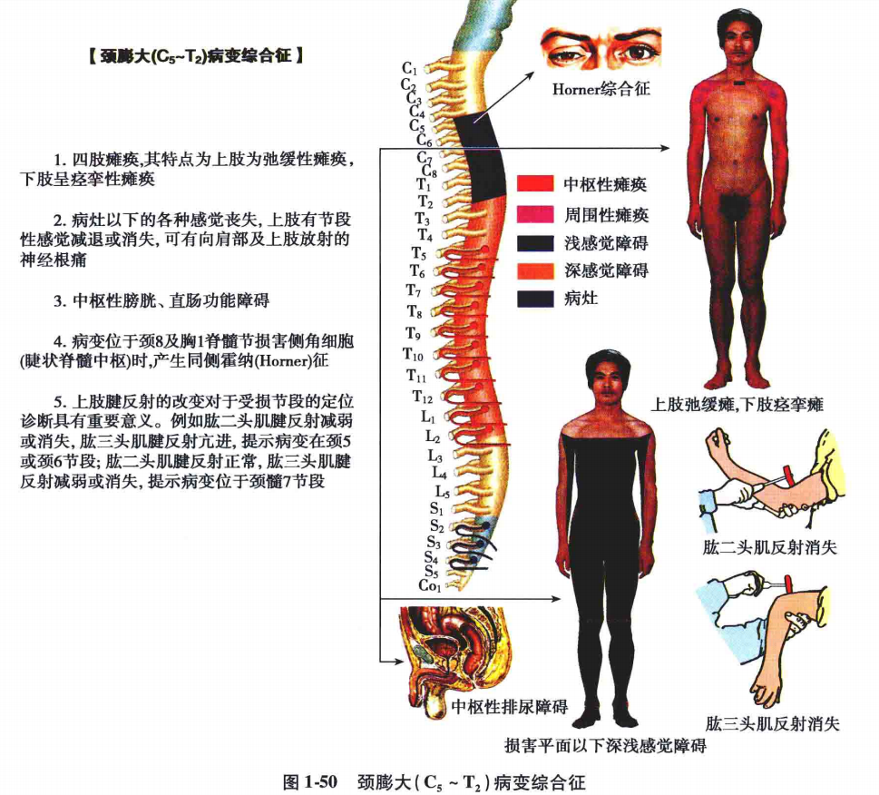 中枢神经系统疾病定位诊断图解脊髓水平面上的病变定位