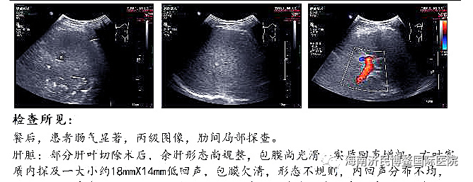 博鳌国际医院创造生命奇迹，晚期恶性黑色素瘤患者送旗感恩插图7