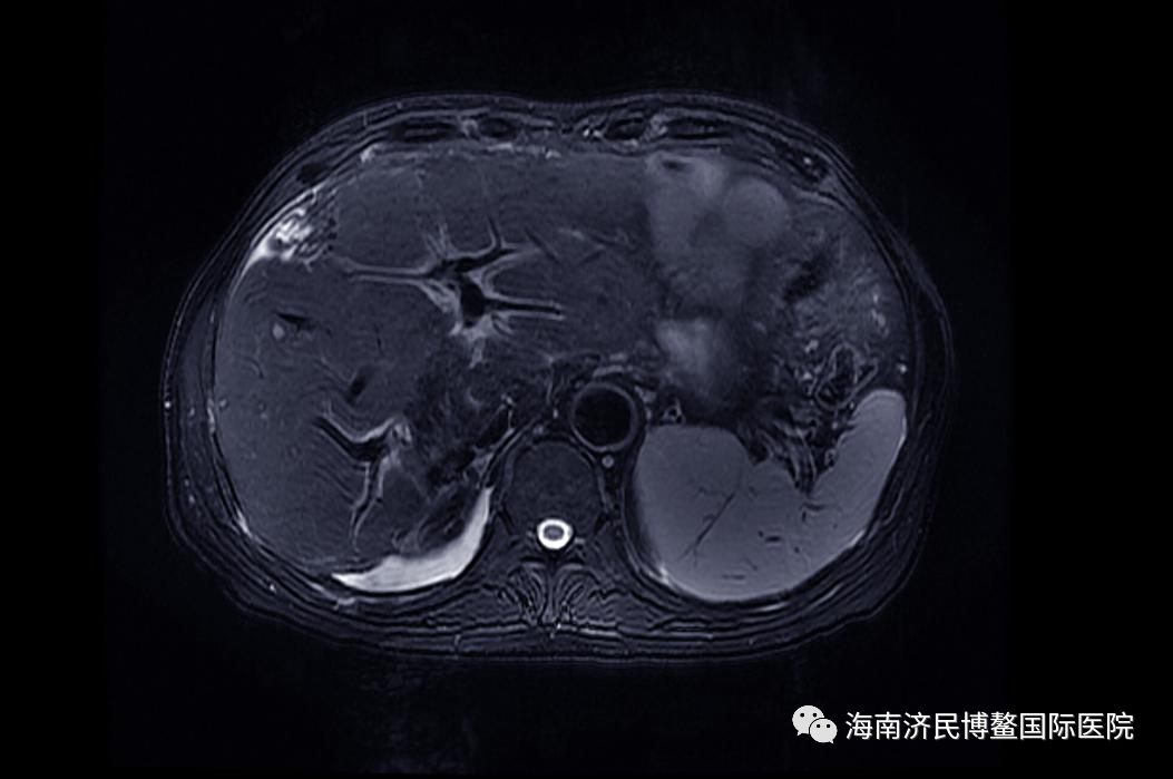 博鳌国际医院创造生命奇迹，晚期恶性黑色素瘤患者送旗感恩插图4
