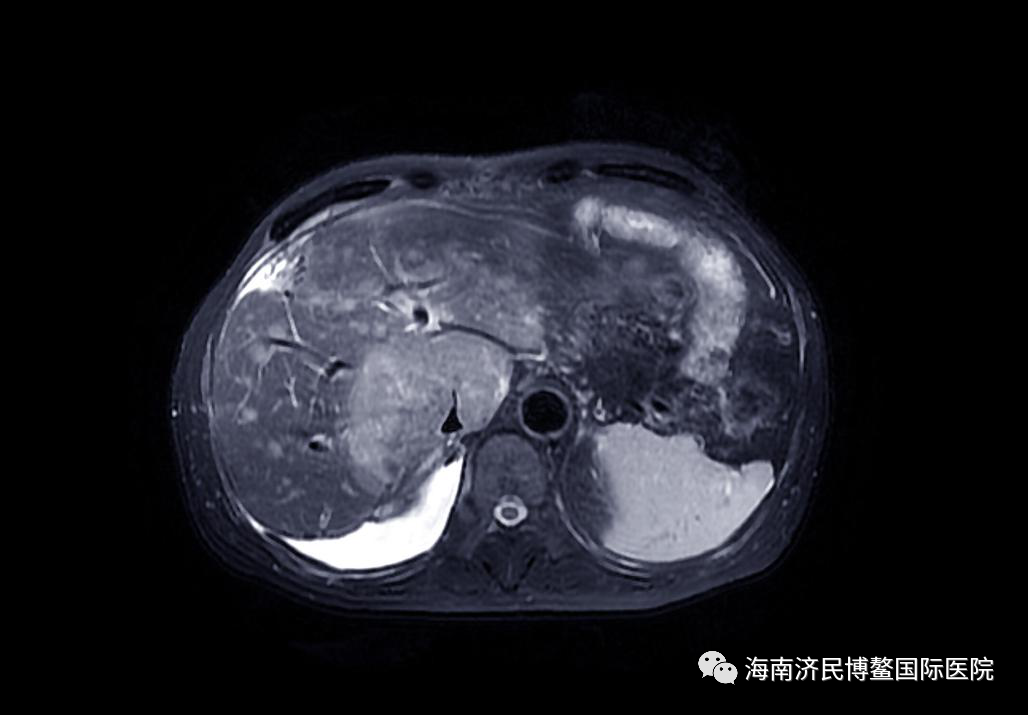 博鳌国际医院创造生命奇迹，晚期恶性黑色素瘤患者送旗感恩插图2