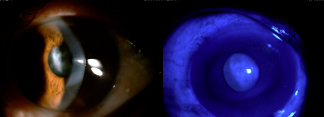眼科检查仪器叫什么【眼科检查】眼科放大镜——裂隙灯生物显微镜到底查什么？_https://www.jmylbn.com_新闻资讯_第35张