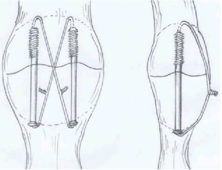 髌骨骨折治疗新进展（2024）