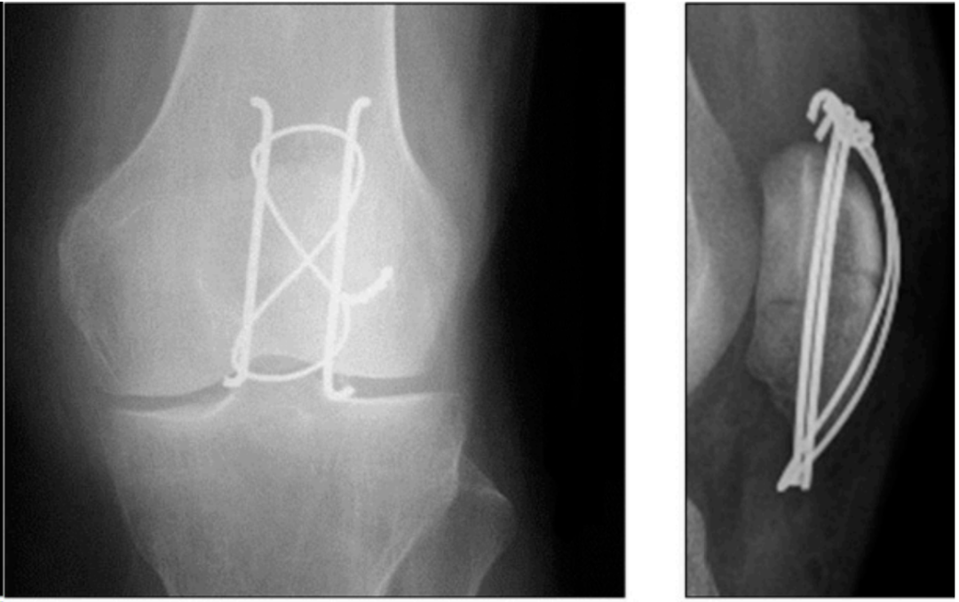 髌骨骨折治疗新进展（2024）