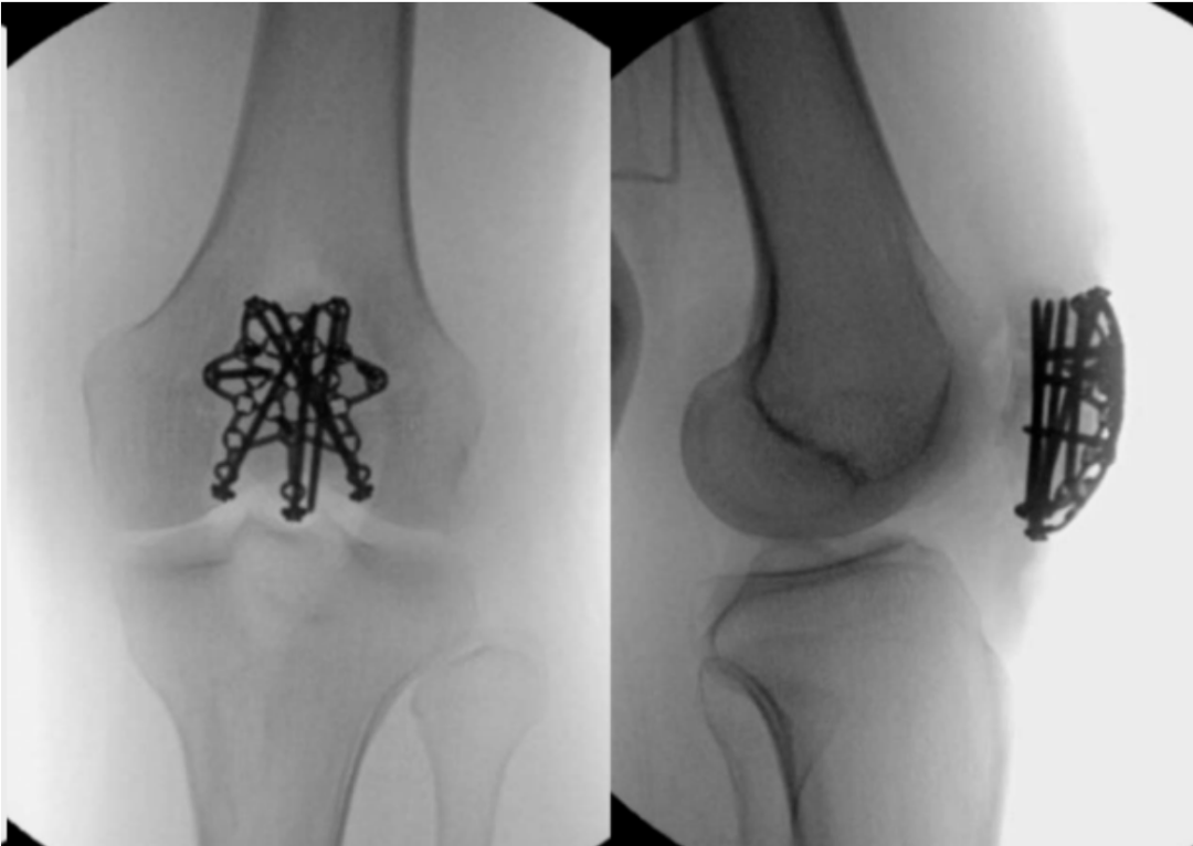 髌骨骨折治疗新进展（2024）