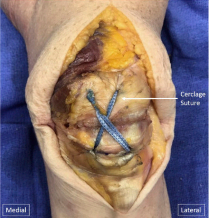 髌骨骨折治疗新进展（2024）