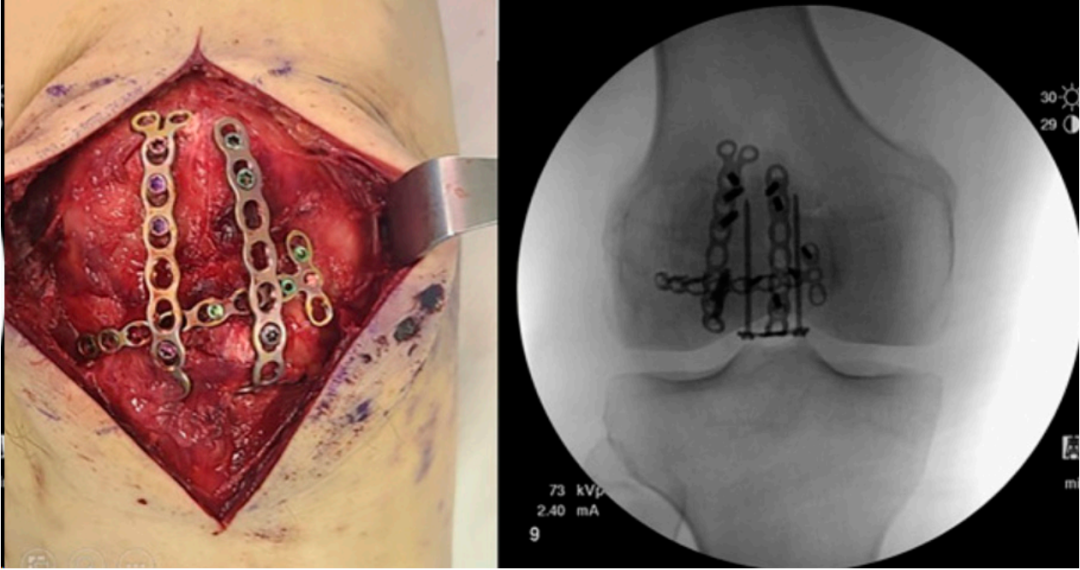 髌骨骨折治疗新进展（2024）