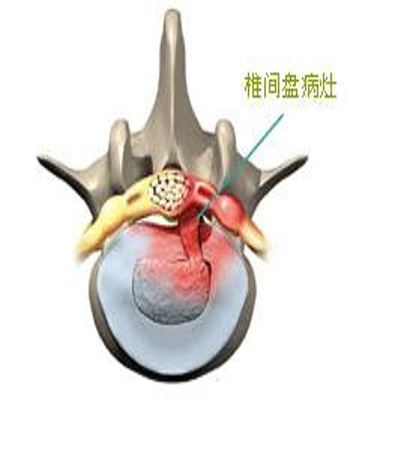 微创技术在脊柱外科中的应用