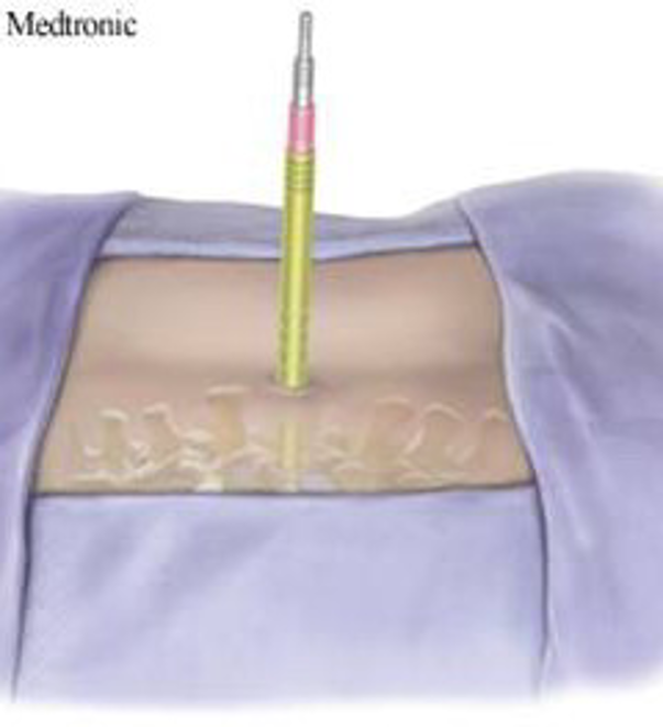 微创技术在脊柱外科中的应用