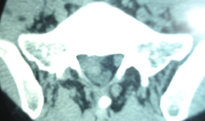 微创技术在脊柱外科中的应用