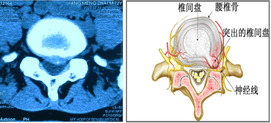 微创技术在脊柱外科中的应用