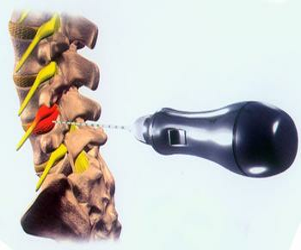 微创技术在脊柱外科中的应用