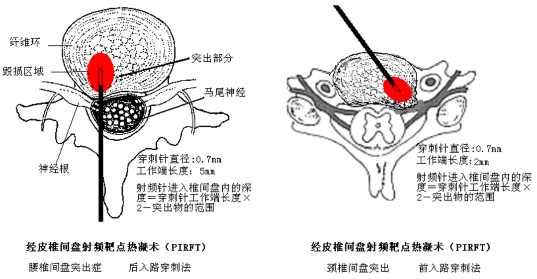 微创技术在脊柱外科中的应用