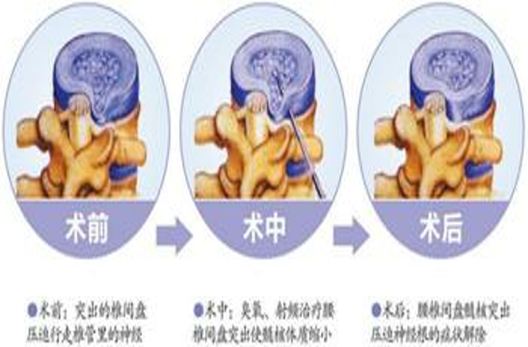 微创技术在脊柱外科中的应用