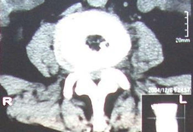 微创技术在脊柱外科中的应用