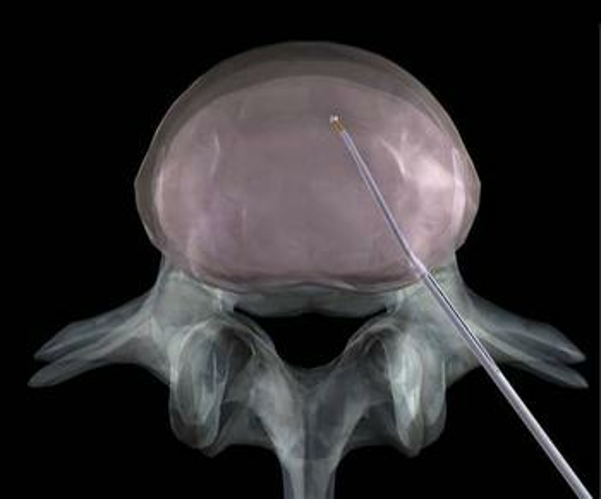 微创技术在脊柱外科中的应用