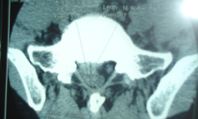 微创技术在脊柱外科中的应用