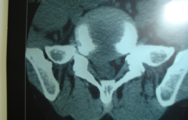 微创技术在脊柱外科中的应用
