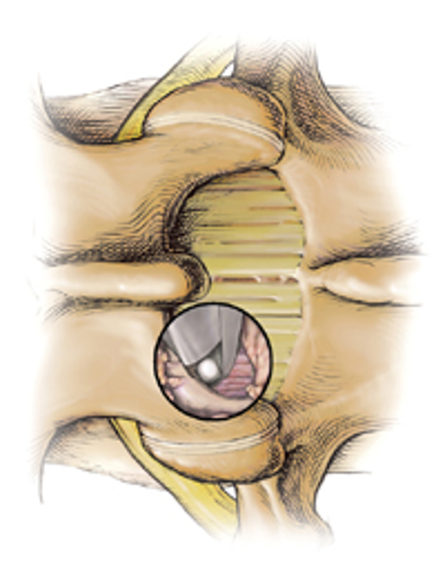 微创技术在脊柱外科中的应用