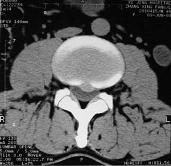 微创技术在脊柱外科中的应用