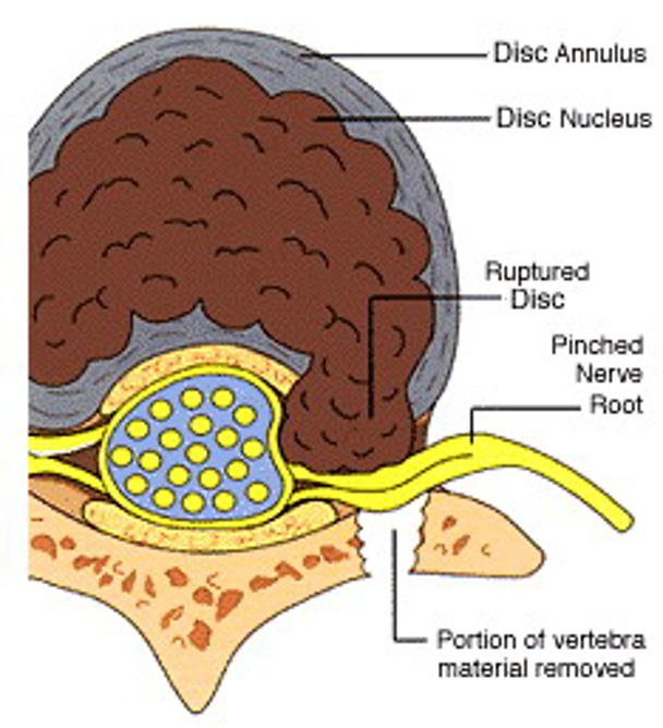 微创技术在脊柱外科中的应用