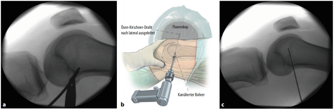髌骨脱位怎么办？骨科医生详解MPFL重建方案